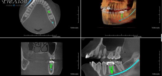 implant planning molar_800